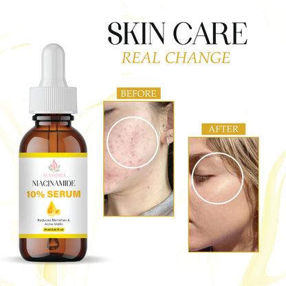 10% Niacinamide Face Serum for Acne Marks, Oil Control & Brightening | Reduces Dark Spots, Minimizes Pores & Strengthens Skin Barrier | Lightweight, Non-Greasy Formula
